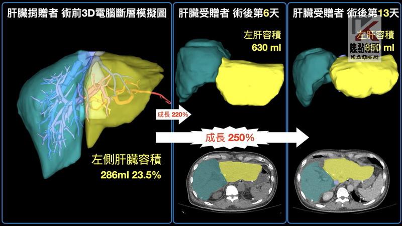 台灣新曙光　高雄長庚成功兩階段活體肝移植手術