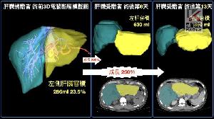 台灣新曙光　高雄長庚成功兩階段活體肝移植手術